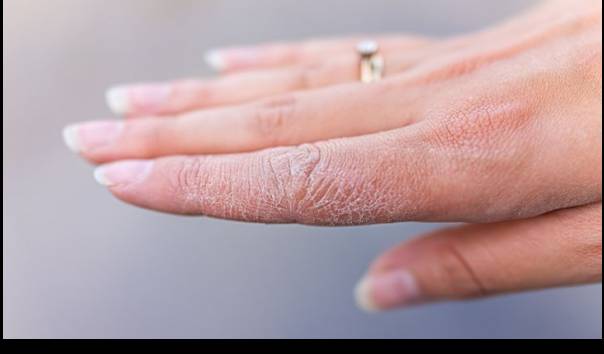 5 Tips Mengatasi Secara Alami Kulit Tangan Yang Terasa Kering