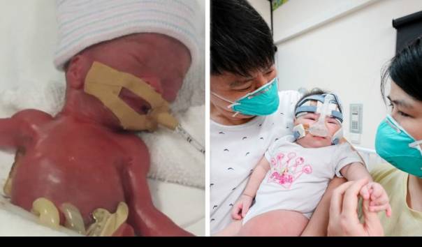 Bayi Prematur Teringan Di Dunia Yang Lahir Hanya 212 Gram Kini Makin Sehat Dan Gembil Menggemaskan
