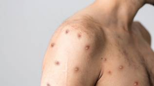 soal-kans-cacar-monyet-jadi-pandemi-begini-penjelasan-epidemiolog