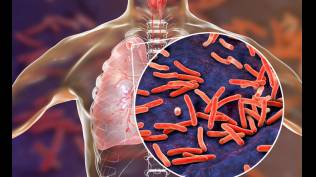 who-kasus-tuberkulosis-meningkat-secara-global-untuk-pertama-kalinya-dalam-beberapa-tahun-terakhir