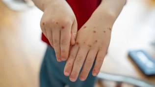 penanganan-campak-kemenkes-fokus-di-10-wilayah-dengan-angka-tertinggi