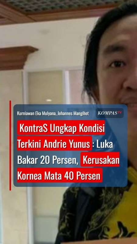Kondisi Terkini Andrie Yunus: Luka Bakar 20 Persen, Kerusakan Kornea Mata 40 Persen
