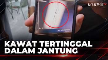 Pria Di Samarinda Diduga Jadi Korban Malapraktik, Kawat 2 Cm Tertinggal Di Jantung | SAPA PAGI
