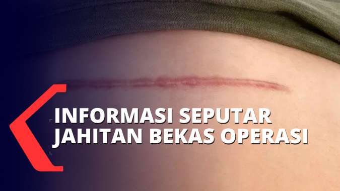 Informasi dari Dokter Spesialis Bedah Seputar Benang Jahitan & Kulit